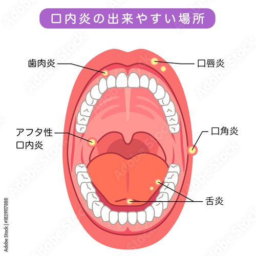 Foto 口内炎の出来やすい場所　口の中　医療