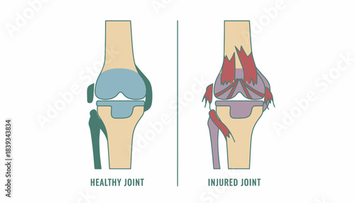 An illustration of a healthy joint comparing it with an injured joint to highlight the benefits of flexibility and strength training.