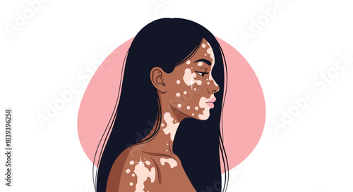 A beautiful woman with vitiligo and long dark hair is shown in a side profile portrait promoting diversity and self love.