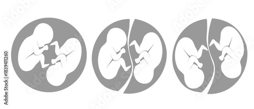 Three ultrasound images showing different stages of twin fetuses development during pregnancy, illustrating growth and movement inside the womb. Multiple pregnancy. Monozygotic twins (embryos). 