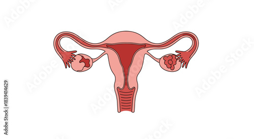 Medical illustration of the female reproductive system showing the uterus ovaries fallopian tubes and potential fibroids.