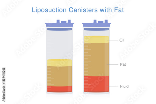 Liposuction canister that has fat, fluid and oil containing inside. Liquid suction from patient's body in beauty clinic. Plastic tube with measurement and blue lid.