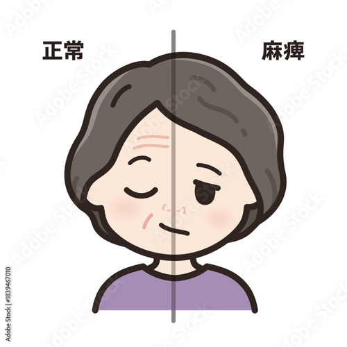 左顔面神経麻痺のイラスト_正常と麻痺の比較