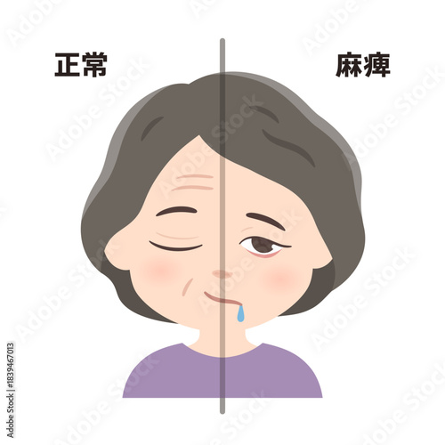 左顔面神経麻痺のイラスト_正常と麻痺の比較