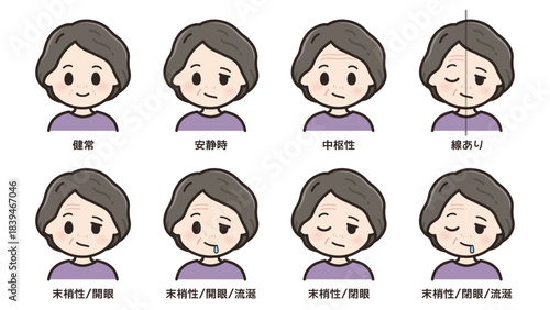 左顔面神経麻痺のイラスト素材セット