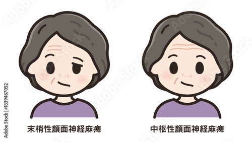 左顔面神経麻痺のイラスト_末梢性と中枢性の比較