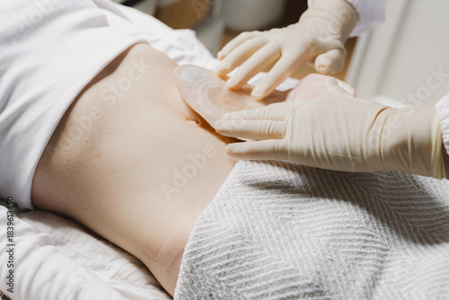 A nurse wearing gloves attaches a colostomy bag to a girl patient's stomach.