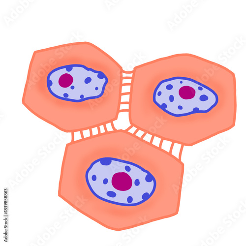 Picture of neoplastic squamous cells, showing enlarged nuclei, coarse clumping chromatin, prominent nucleoli and intercellular bridge