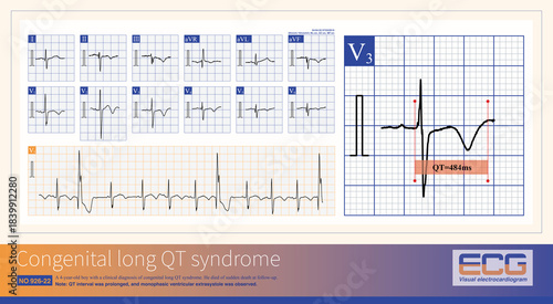 Patients with congenital long QT syndrome are at risk of developing complex ventricular premature contractions, paroxysmal ventricular tachycardia, torsades de Pointes, and ventricular fibrillation.
