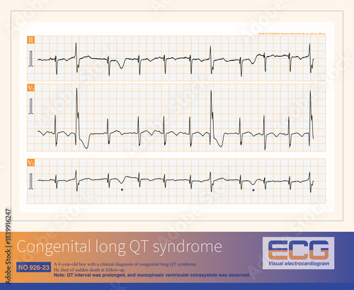 Patients with congenital long QT syndrome are at risk of developing complex ventricular premature contractions, paroxysmal ventricular tachycardia, torsades de Pointes, and ventricular fibrillation.
