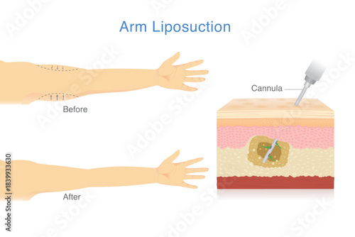 Reduce excess arm fat with Liposuction. Woman make sagging arm look firmer and more beautiful. Skin layer showing Cannula removes excess fat from the inner layers of the skin.