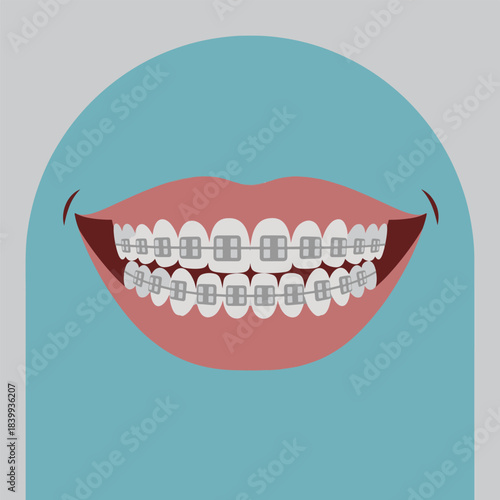 Smiling Mouth with Dental Braces Orthodontic Treatment for a Perfect Smile