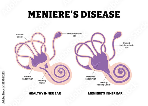 The Meniere's disease. Buildup of fluid in inner ear disorder in stuffy ear. Labeled canal, buldged endolymphatic sac, swelling hearing canal. Flat vector. Medical science educational illustration