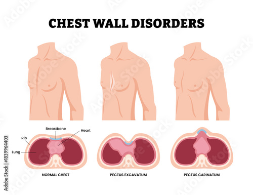 Different types of chest wall disorders types with cross section view. Labeled pectus excavatum carinatum. Ribs sunken funnel heart murmur lung COPD. Medical science educational illustration