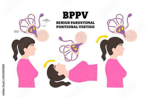 BPPV or benign paroxysmal positional vertigo syndrome. Labeled woman with various position and ear canal disease anatomy with spinning and dizziness sensation cause. Medical education poster.
