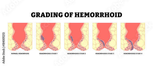 Grading of hemorrhoid stages. Gradual proliferation of hemorrhoidal plexuses. Anatomy of the human anus. showing internal and external hemorrhoids in the rectal and anal region. Medical illustration.