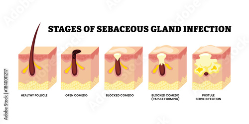 Stages of sebaceous gland infection stages development process. Labeled healthy follicle, open blocked comedo pustule, severe infection. Acne pimple formation. Medical science educational illustration