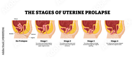 The stages of uterine prolapse stages development process. Labeled bladder, rectum, vagina, uterus. Pelvic floor muscles weakening, Support for the uterus loss.Medical science educational illustration
