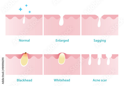 Infographic of pore problems illustration. Normal, enlarged, sagging, blackhead, whitehead and acne scar pores on skin layer. Caused by excess oil production, clogged, sun damage, loss of elasticity.