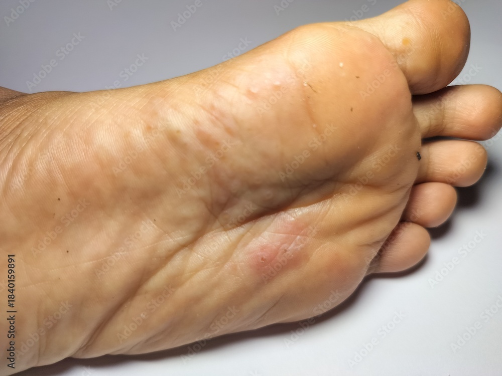 Fototapeta premium scabies, skin infection, child health, flood aftermath, Sarcoptes scabiei, dermatology, infectious disease, post-disaster illness, humanitarian crisis, tropical disease, hygiene-related illness, Malay