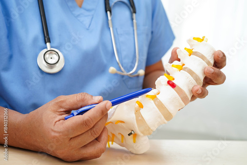 Asian doctor holding spinal nerve and bone model, Lumbar spine displaced herniated disc fragment for treatment medical in the orthopedic department.