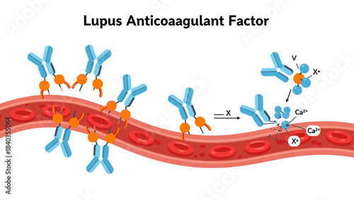 Lupus Anticoagulant Factor (LA) Mechanism in Blood Clotting Pathway