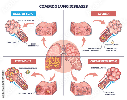 Healthy lung diagram shows lungs, alveoli, and bronchiole with comparisons to asthma, pneumonia, and COPD, explaining airway health at a glance, transparent background.