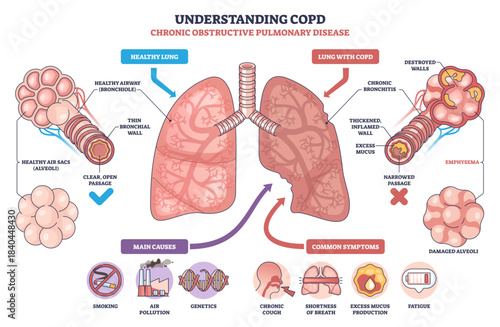 Understanding COPD, brief visual contrasts healthy lung with COPD lung, showing bronchi, mucus, and damaged alveoli to explain airflow obstruction and symptoms, transparent background.