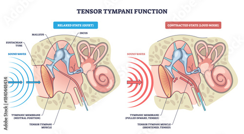 Tensor tympani function, contrasts relaxed vs contracted states, showing tympanic membrane, malleus-incus chain, and sound waves that dampen loud input to protect hearing, transparent background.