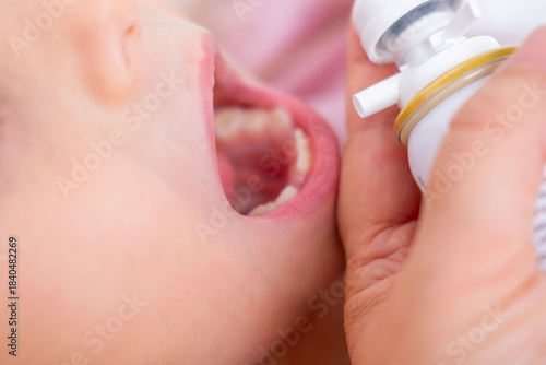 Closeup child's open mouth receiving aerosol spray from hand-held bottle, suggesting treatment for sore throat, tonsillitis, asthma, or allergy quick relief, young patient receiving medicated spray