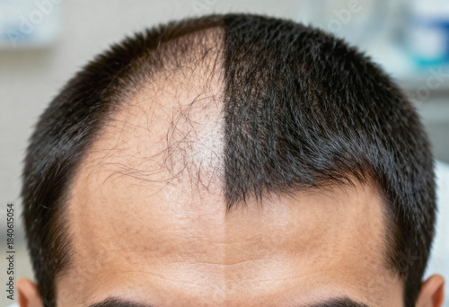 The image shows a close-up view of a man's scalp with a clear vertical division showing balding on the left side and healthy hair growth on the right, illustrating a before-and-after state