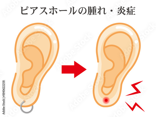 ピアス穴のトラブルで痛む耳のイラスト素材