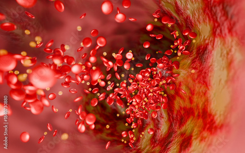 Artery narrowing due to cholesterol deposits, fast food intake, high-sugar beverages, alcohol addiction, and processed foods, emphasizing risks stroke, and cardiovascular death. 3D rendering