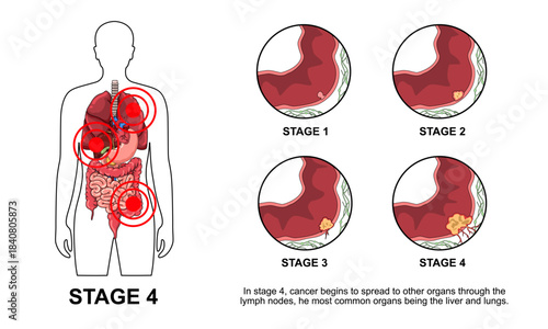Illustration of colorectal cancer stages. Concept of colon cancer progression. Spread of tumor to lymph nodes. Medical vector illustration for clinics, education, and science.