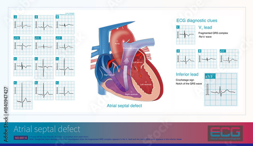 When the fragmented QRS complex appears in the V1 lead of ECG with the notch of QRS wave in the inferior lead, that is, the hook sign, it is necessary to screen for congenital heart disease.
