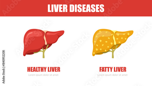 Liver disease. Healthy and fatty liver. Internal organ icons. Medical illustration. Vector design.