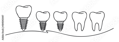 Dental health concept showing dental implants and natural teeth in a line representing oral care progression and restoration for medical marketing.
