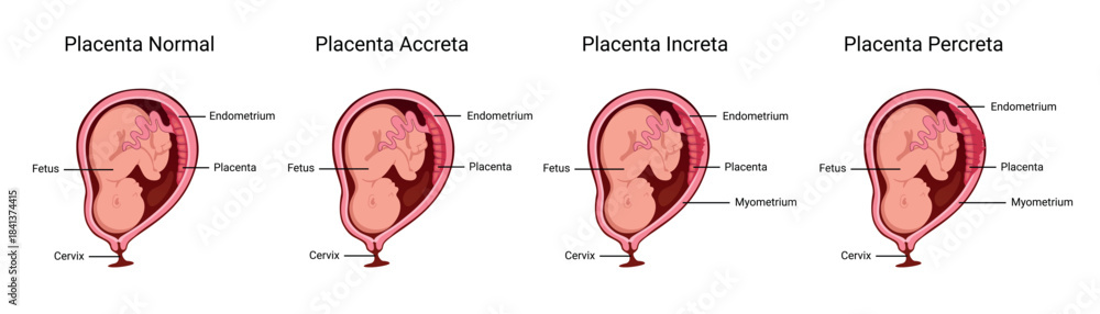 Fototapeta premium Placenta. Part of placenta attaches abnormally to the myometrium. Three grades of attachment according to the depth: Accrete, increta, percreta. Medical vector illustration