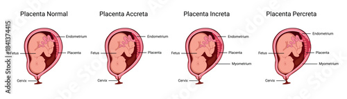 Placenta.  Part of placenta attaches abnormally to the myometrium. Three grades of attachment according to the depth: Accrete, increta, percreta. Medical vector illustration