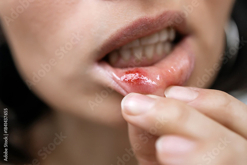 Foto Close-up of a Woman Showing a Painful Canker Sore or Mouth Ulcer on Inner Lower