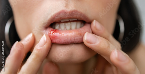 Close-up of a Woman Showing a Painful Canker Sore or Mouth Ulcer on Inner Lower Lip with Red Inflammation, Oral Mucosa Irritation and Dental Health Problem Concept