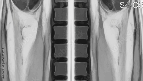 Detailed Radiographic Image of the Spinal Column S4-C5 for Medical Diagnostics