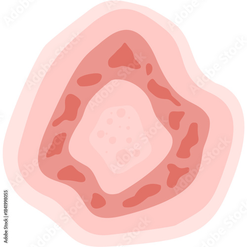 Dermatophytosis illustration