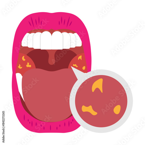 Mouth Infection Illustrator