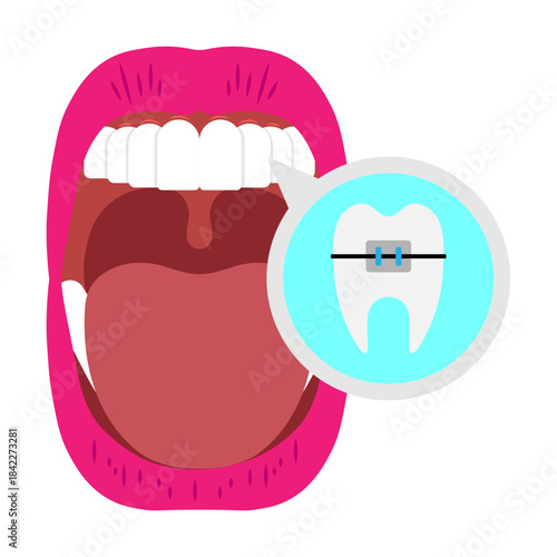 Mouth Infection Illustrator