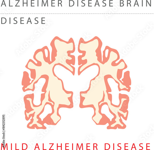 ALZHEIMER Mild alzheimer disease