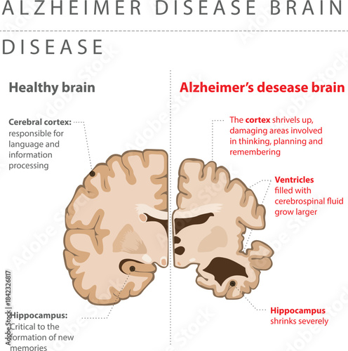 ALZHEIMER