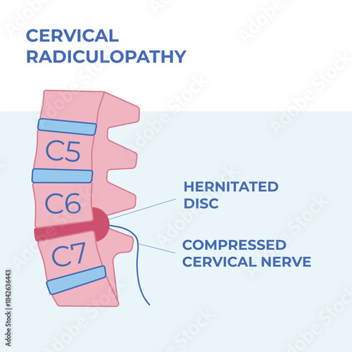Medical vector illustration focusing on a cervical spine herniated disc causing nerve root compression. Detailed anatomical view without pain distribution, ideal for clinical explanations, presentatio