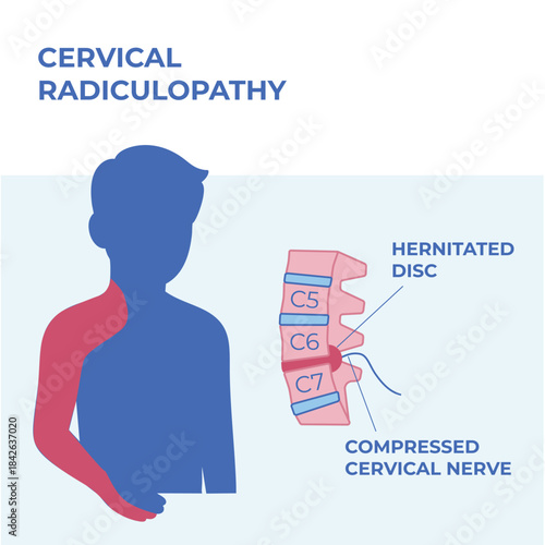 Medical vector illustration showing cervical radiculopathy caused by a herniated disc, with highlighted nerve compression and radiating pain areas in the neck, shoulder and arm. Includes anatomical la