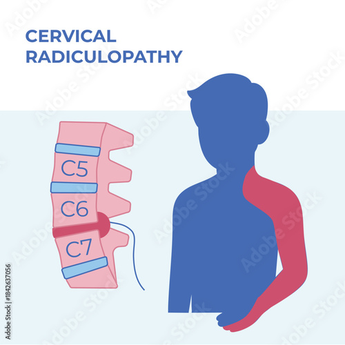 Vector medical illustration of cervical radiculopathy showing a herniated disc and corresponding pain areas in the neck, shoulder and upper limb. Clean anatomical visualization suitable for medical, e